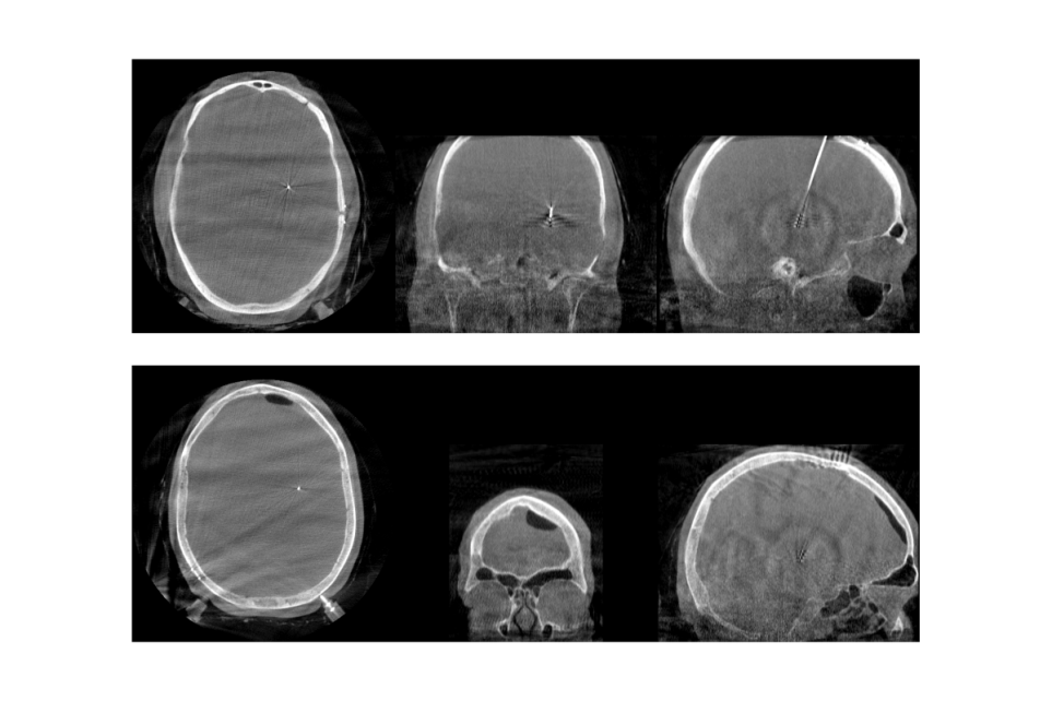 MRI photos of one normal brain and one that has been affected by an air shaft
